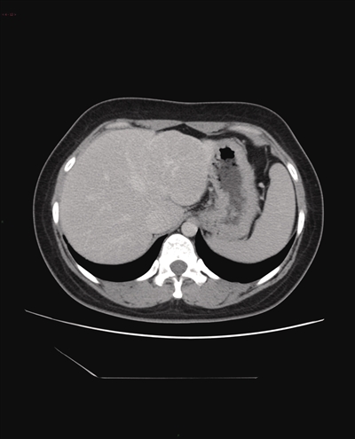 肝脏常见局灶性病变的CT影像征象分析
