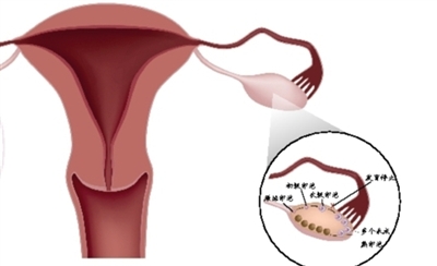 多囊卵巢综合征的中医辨证论治