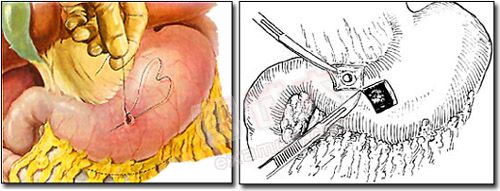 胃、十二指肠溃疡穿孔修补术