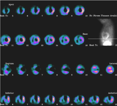 图1 误诊为扩张型心肌病的心肌梗死患者核素心肌灌注显像 (静息)检查结果