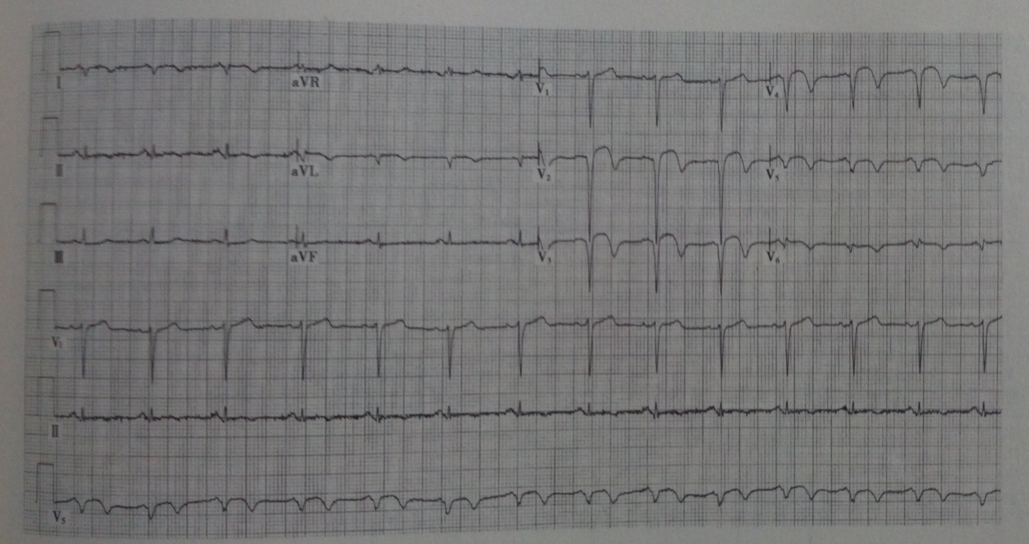 读图识“心” 心电图诊断（13）
