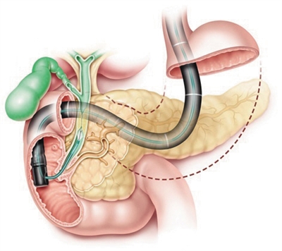 消化内镜技术发展30年 