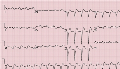 读图识“心” 心电图诊断
