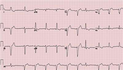 读图识“心” 心电图诊断