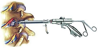 经皮椎间孔入路内镜下手术治疗腰椎间盘突出症