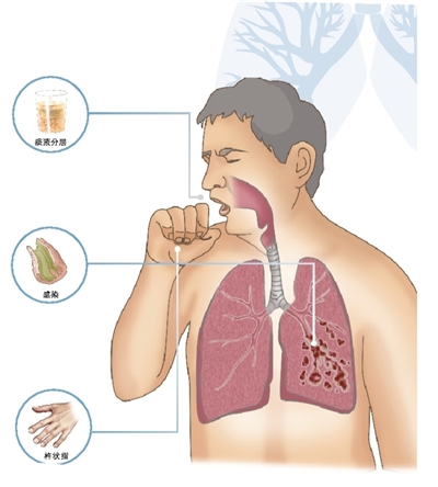重视支气管扩张症的诊断