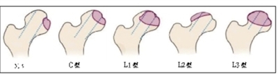 股骨头坏死分型