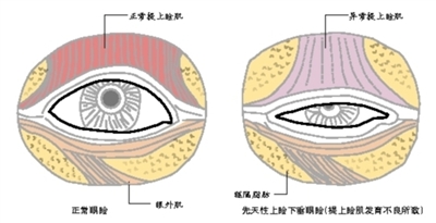 认识先天性上睑下垂