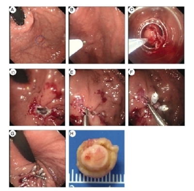 胃底固有肌肿瘤切除及穿孔闭合术