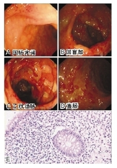 反复间断黏液脓血便2年