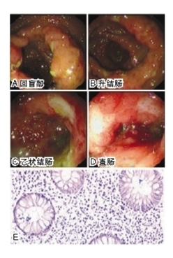 反复间断黏液脓血便2年