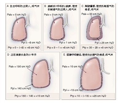 呼吸机诱导肺损伤