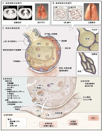 呼吸机诱导肺损伤