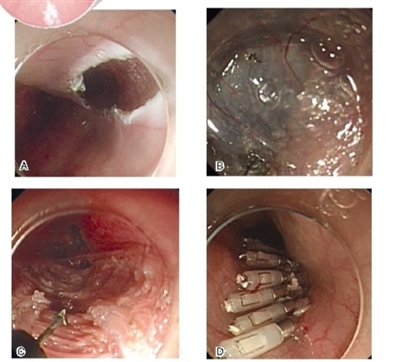 贲门失弛缓症内镜治疗现状