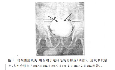 膀肤多发巨大憩室1例分析