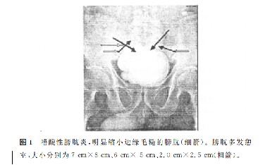 嗜酸性膀胱 明显缩小边缘毛糙的膀胱