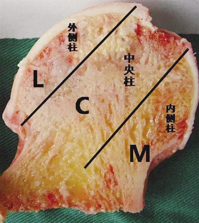 股骨头坏死分型或有“国标”