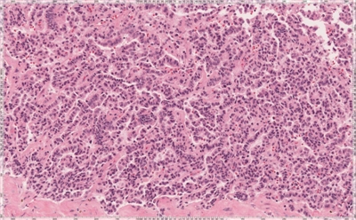肝脏病理切片一例分析（20130726）