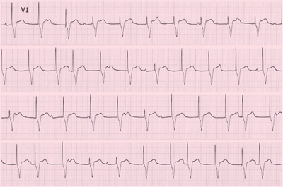心电图分析须密切结合临床