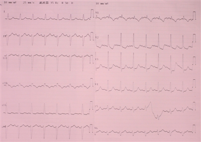 读图识“心” 心电图诊断（16）