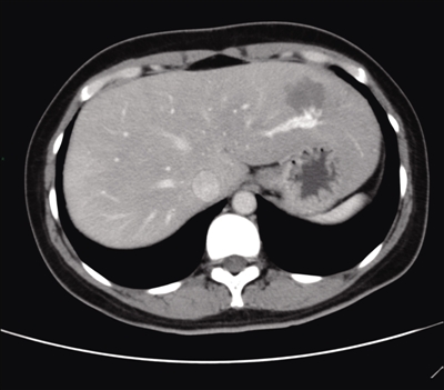 肝脏常见局灶性病变的CT影像征象分析