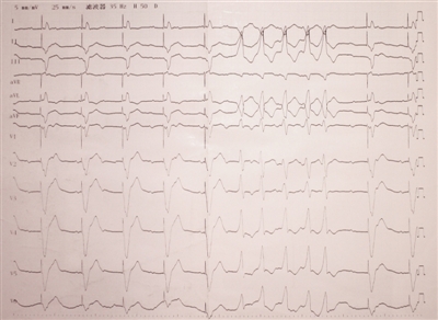 读懂心电图